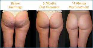 Thermage-before-after-body cellulite